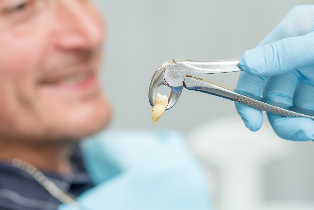 Wisdom Tooth Extraction/Surgical of Wisdom Tooth