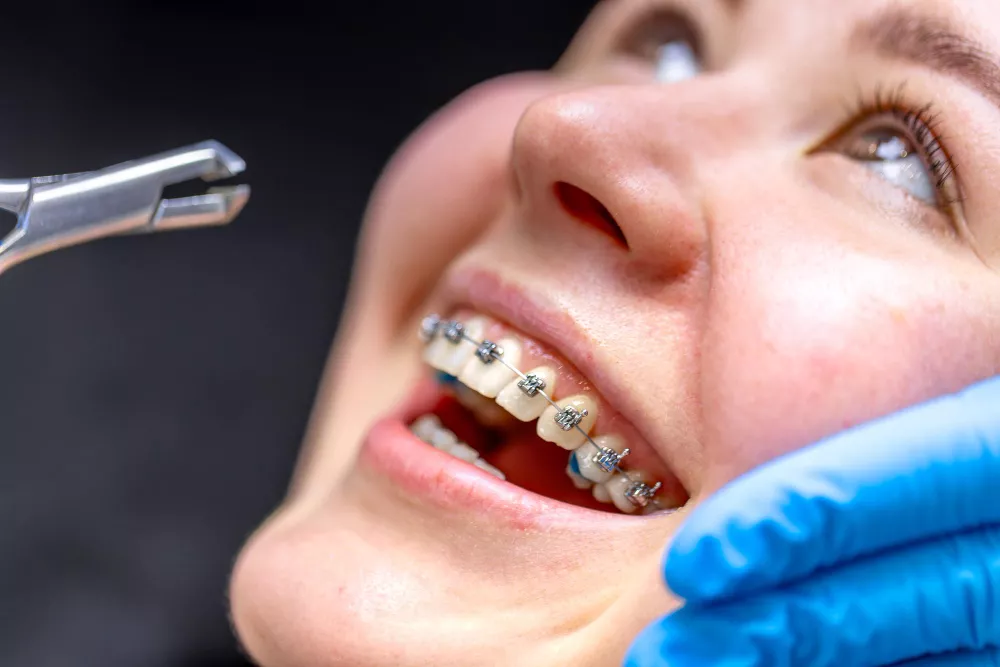 Dental Braces