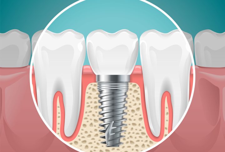 Stomatology illustrations. Dental implants and healthy teeth. Vector health tooth and implant stomatology, dentistry installation and fixture